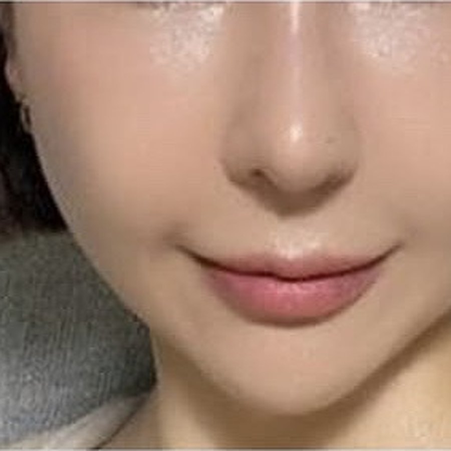실리프팅 수술 후