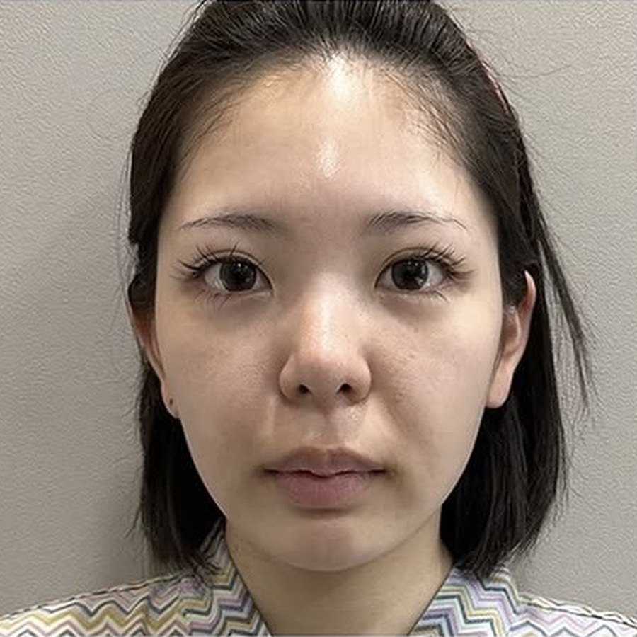 실리프팅 수술 전