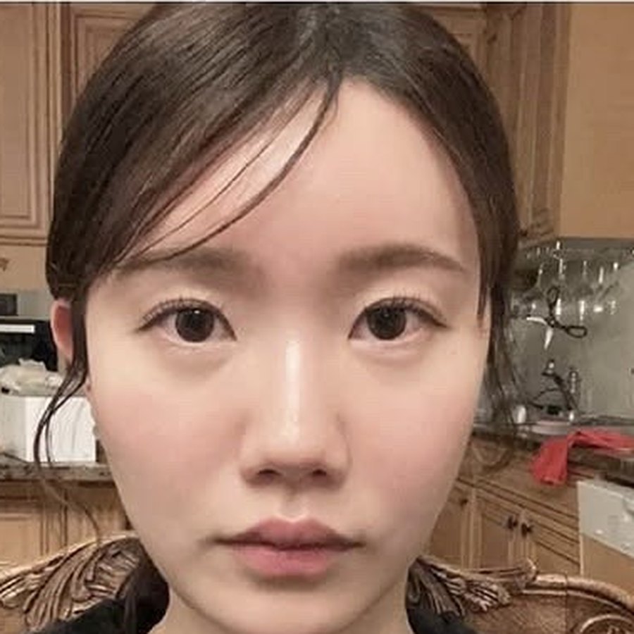 실리프팅 수술 후