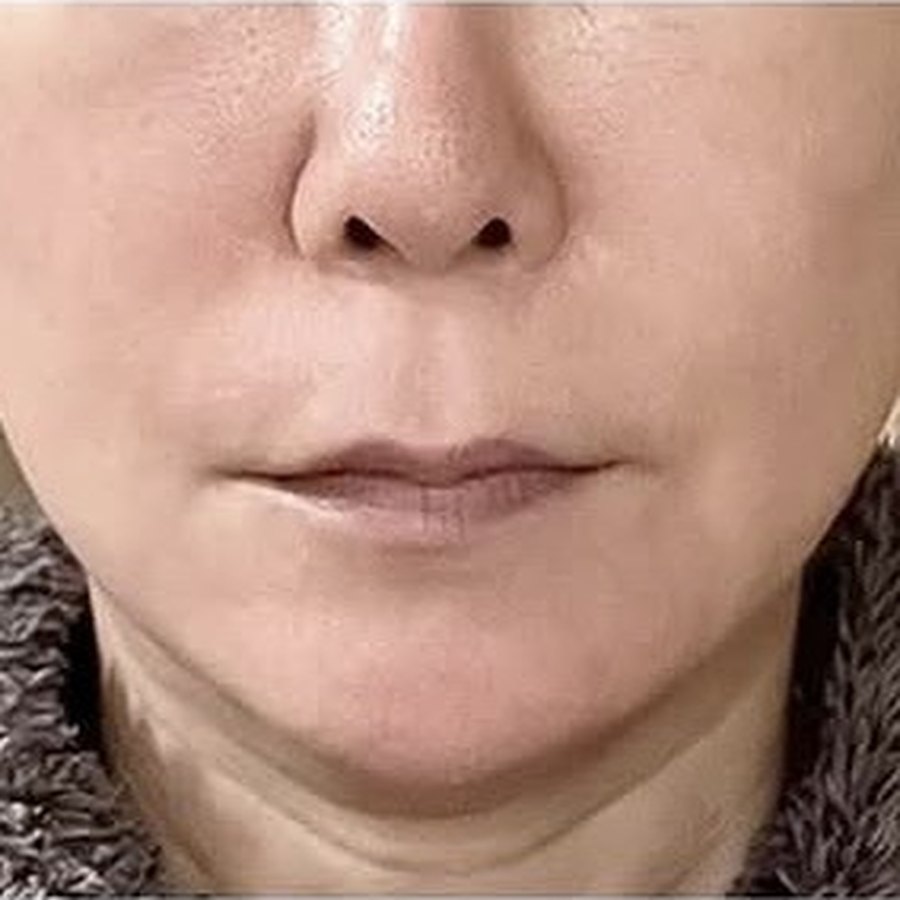 실리프팅 수술 후
