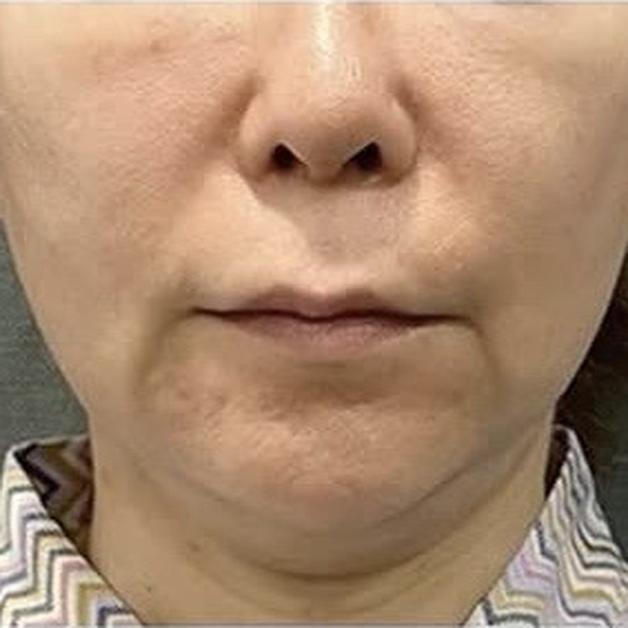 실리프팅 수술 전