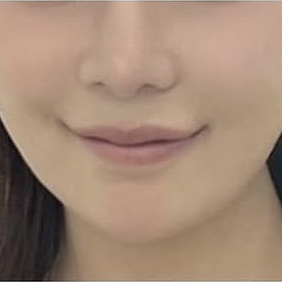 실리프팅 수술 후