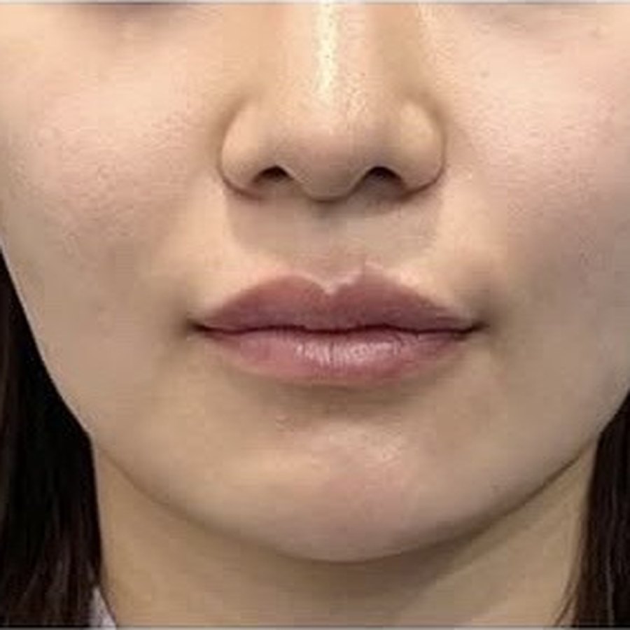 실리프팅 수술 전