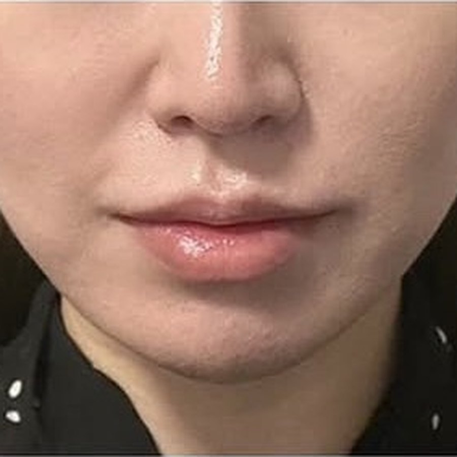 실리프팅 수술 후