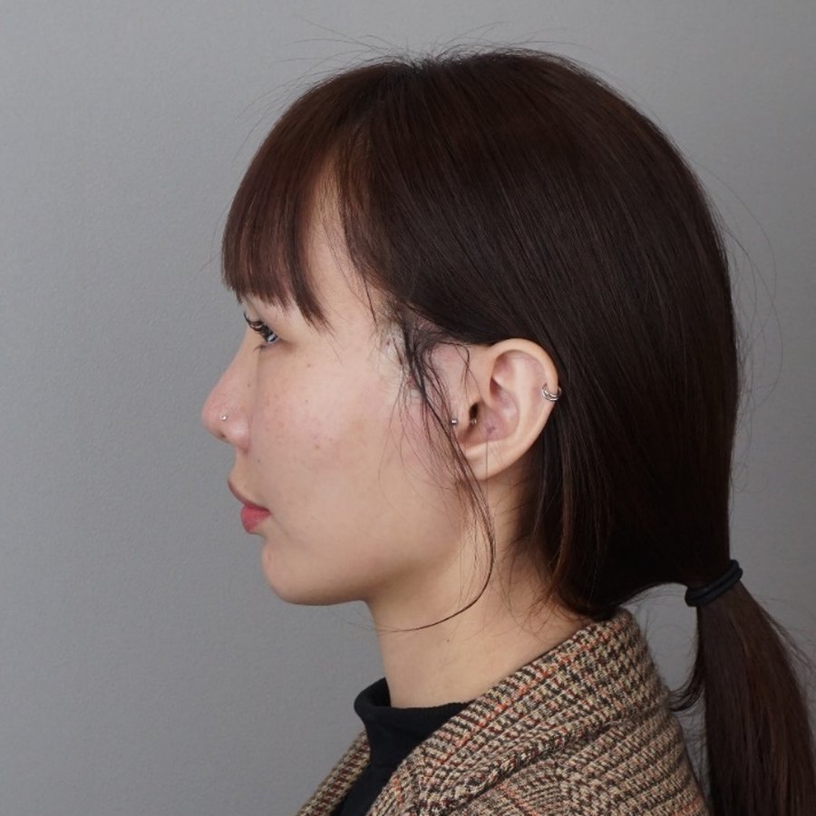 실리프팅 (엘라스티 12줄) · 시술 직후 수술 후