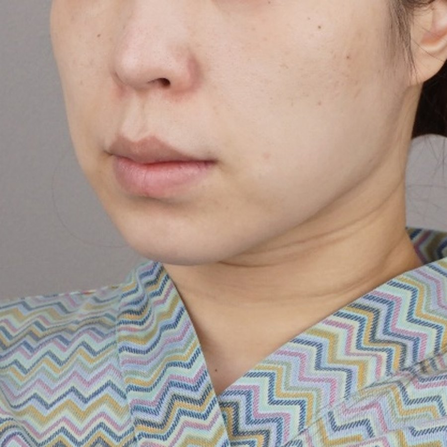실리프팅 (엘라스티 12줄) · 시술 직후 수술 전