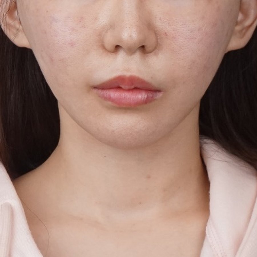 실리프팅 (민트 16줄) · 시술 직후 수술 후