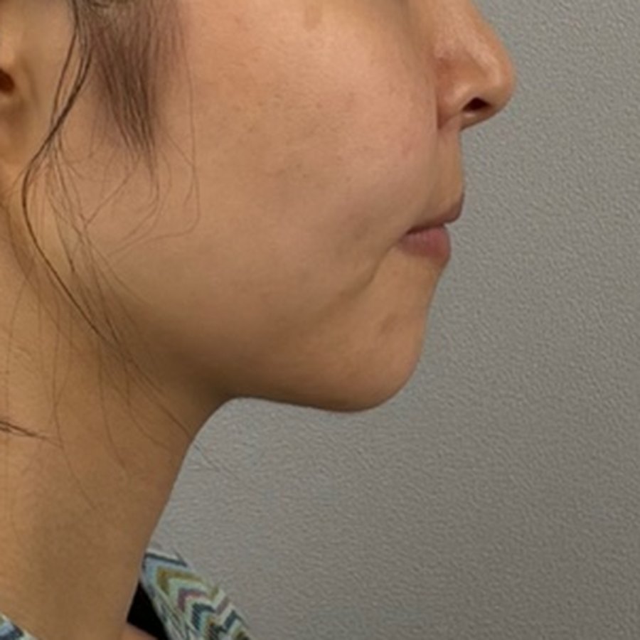 실리프팅 (엘라스티 16줄) + 팔자 필러 1cc · 시술 직후 수술 전