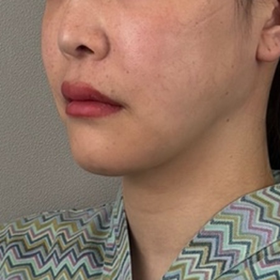 실리프팅 재시술 (미니팅 12줄) · 시술 직후 수술 전